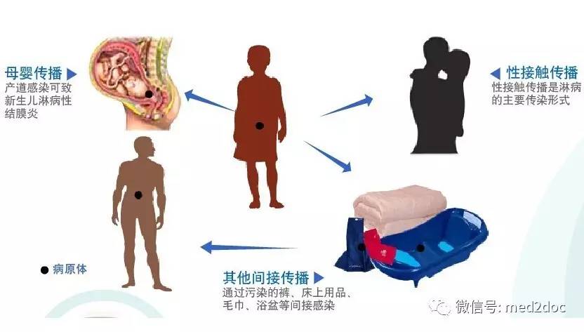 淋病医院_淋病_淋病