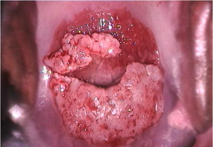 女性尿道口息肉的症状图片