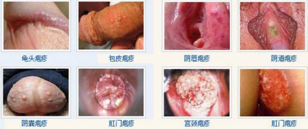 临床上生殖器疱疹图片是怎样的？