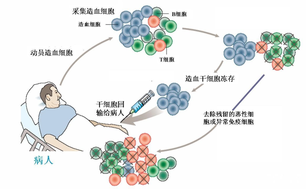 艾滋病治愈