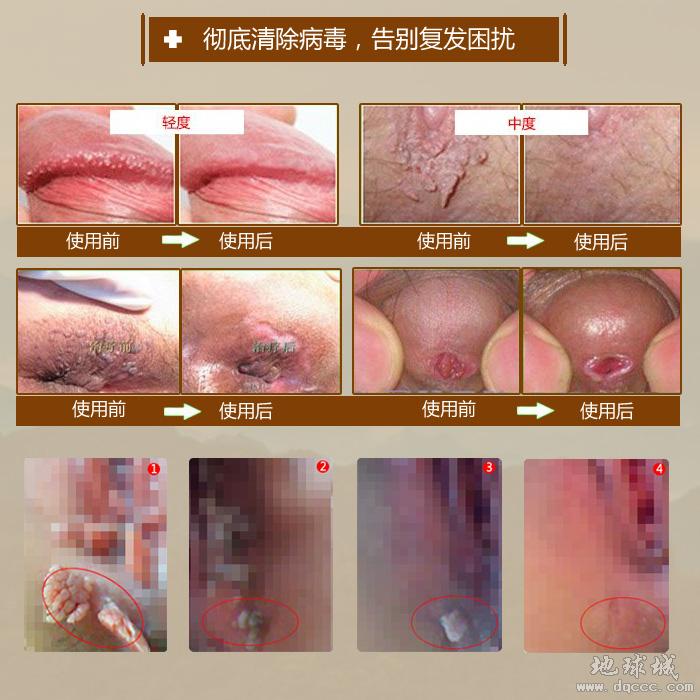 尖锐湿疣是什么病毒_尖锐湿疣病毒_尖锐湿疣病毒种类