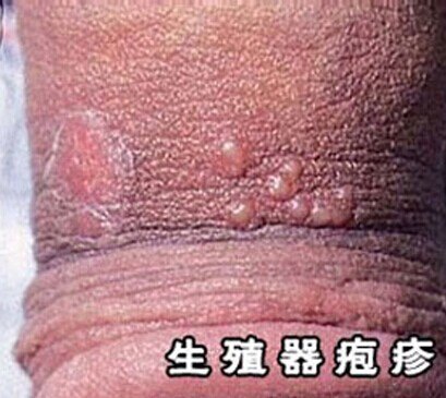 男性生殖器疱疹.jpg
