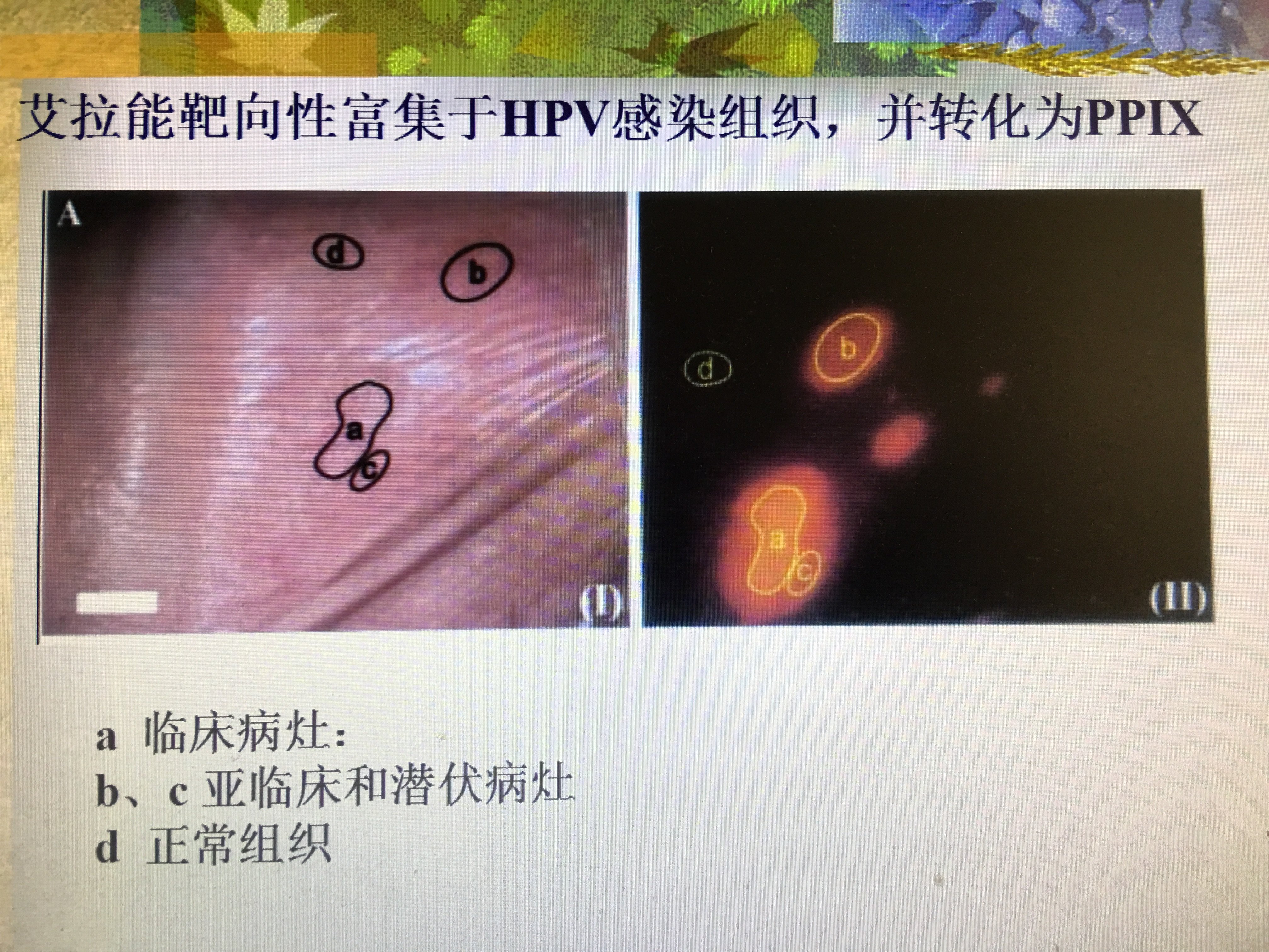 什么是宫颈尖锐湿疣？