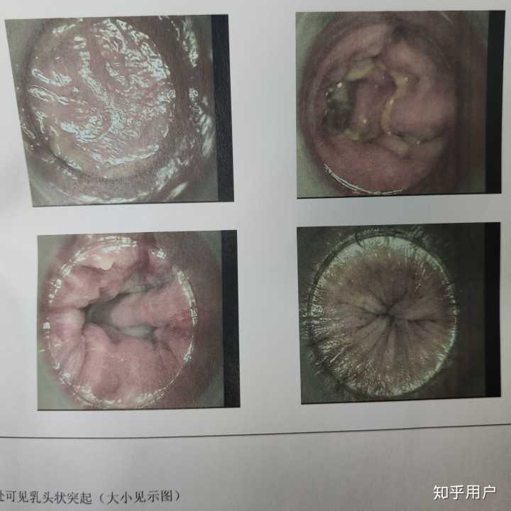 肛门尖锐湿疣_肛门尖锐湿疣_男性肛门尖锐湿疣症状