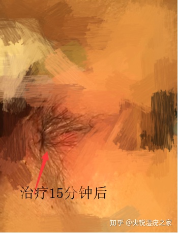 患上尖锐湿疣怎么办