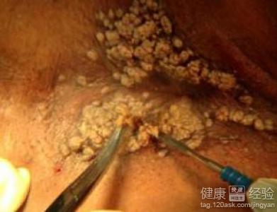 尖锐湿疣能治愈吗？