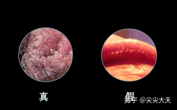 假性尖锐疣与真的照片，教你如何分辨真假湿疣