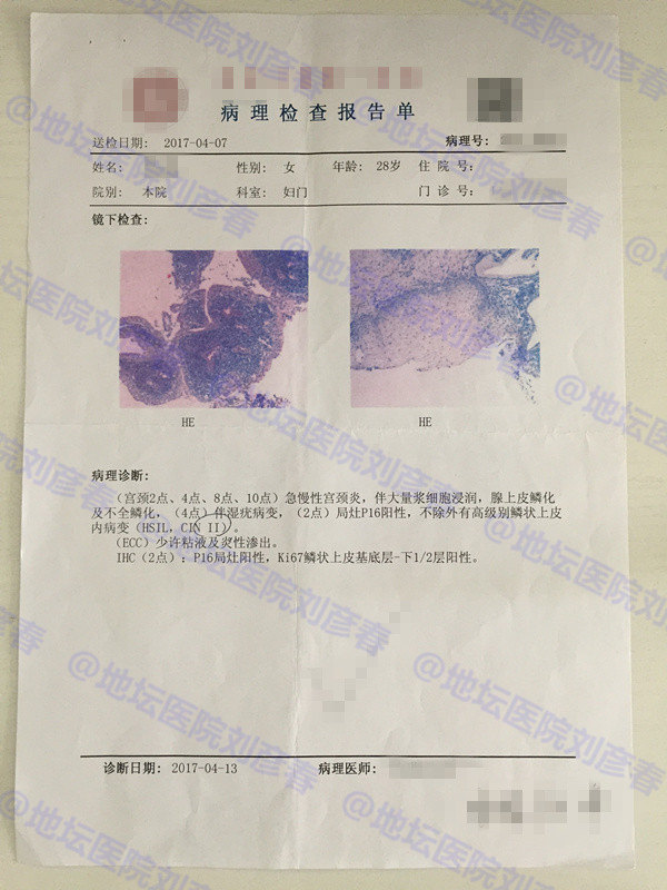 尖锐湿疣怎么治？