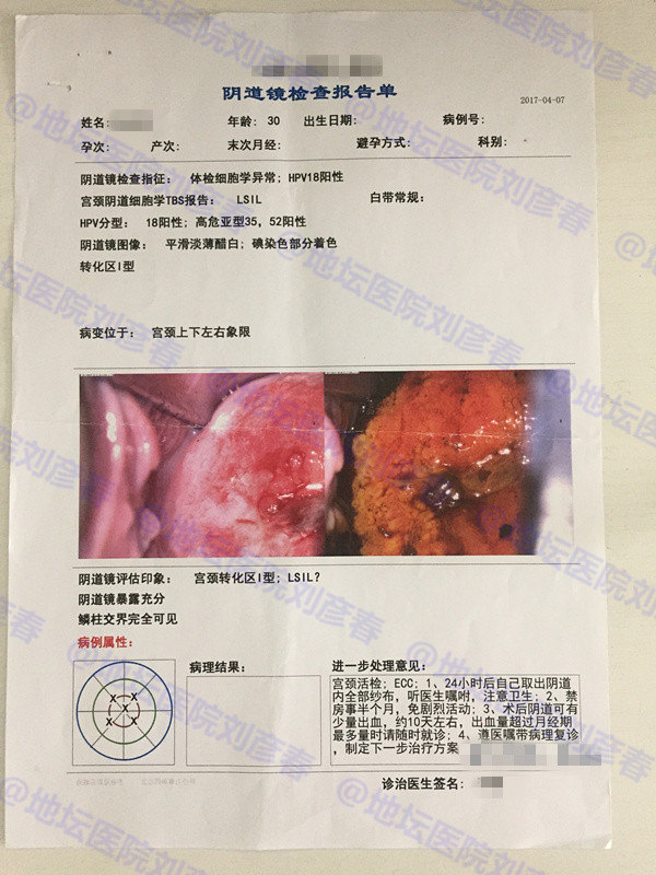 尖锐湿疣长在宫颈怎么办