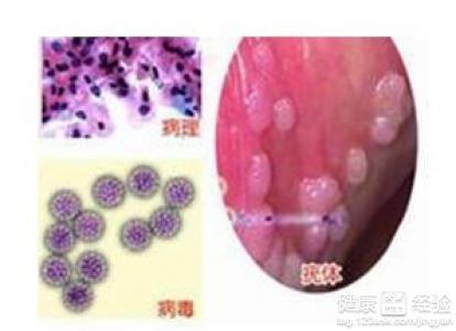 得了尖锐湿疣会有什么后果