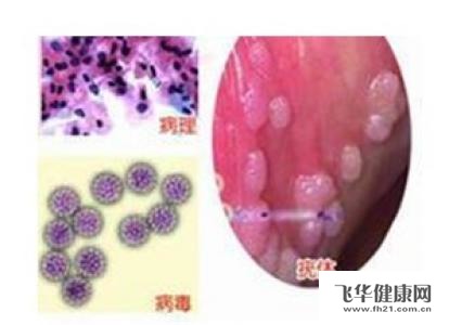 尖锐湿疣可以自愈吗