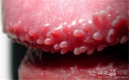 男性尖锐湿疣症状的高清图片？
					已回复