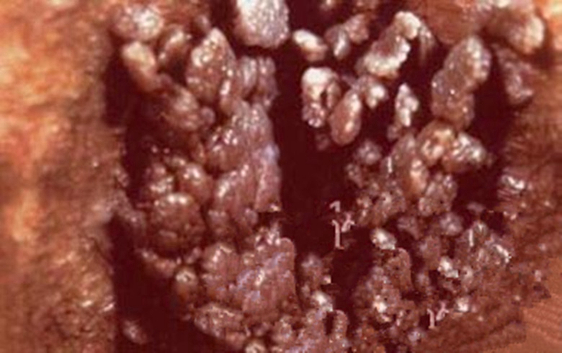 女性感染了hpv，性伴侣有必要做检查吗？