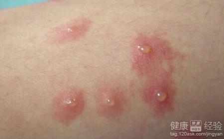 女性尖锐湿疹怎么治疗？ 尖锐湿疣的发病原因