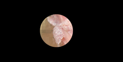 尖锐湿疣患者该注意的是什么