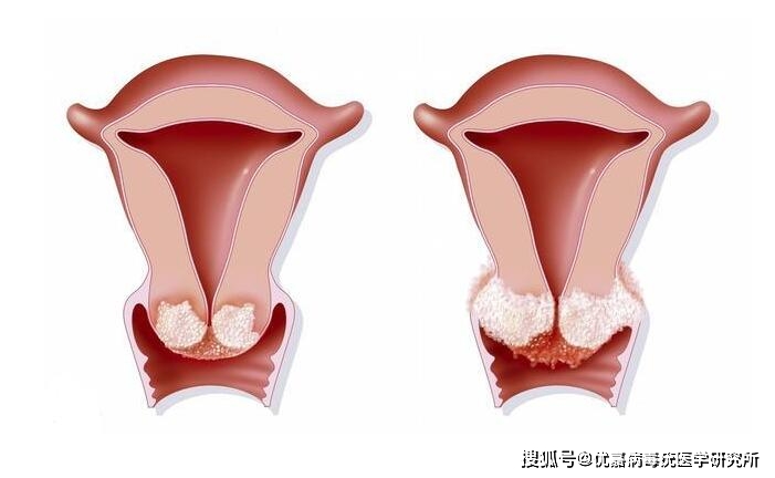 宫颈尖锐湿疣的症状有哪些表现
