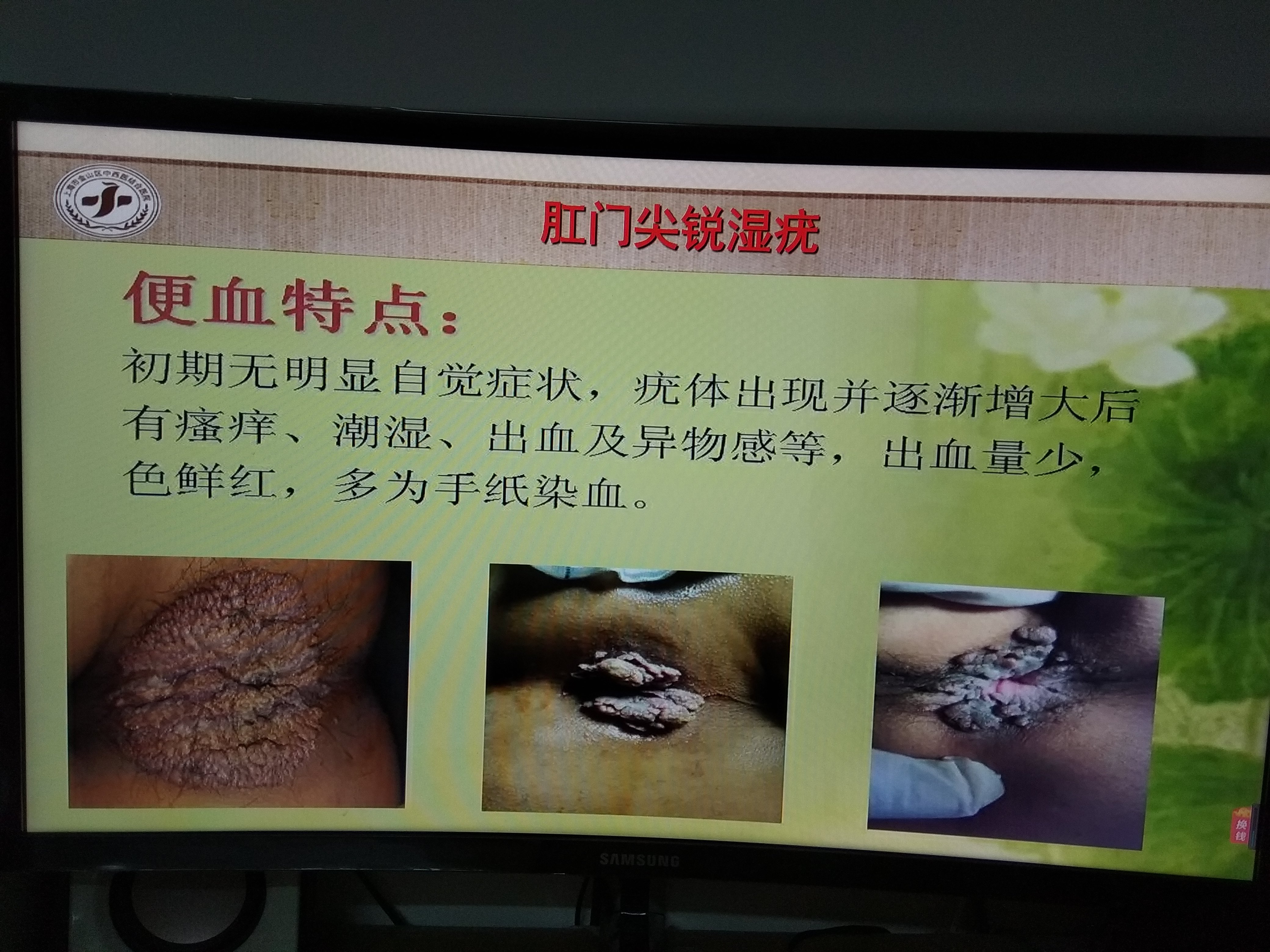 患上尖锐湿疣了该怎么治疗