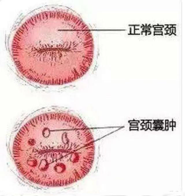 宫颈息肉人工摘除疼吗