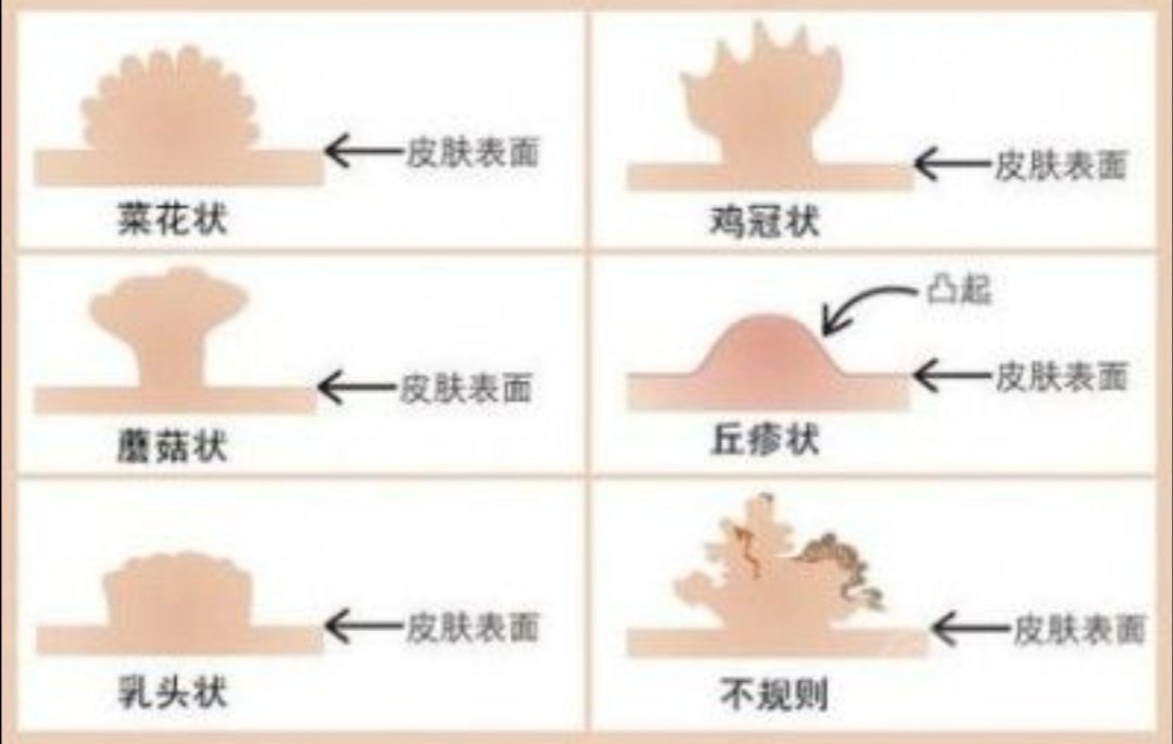 尖锐湿疣尖锐湿疣（condylomaa