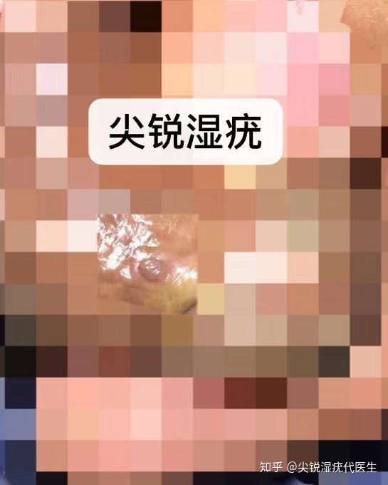 尖锐湿疣有哪些症状表现 发病时患者会有什么感觉？