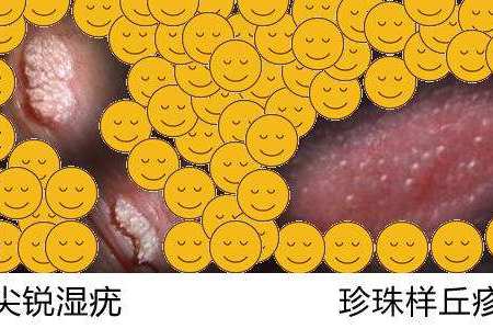 尖锐湿疣是怎么引起的