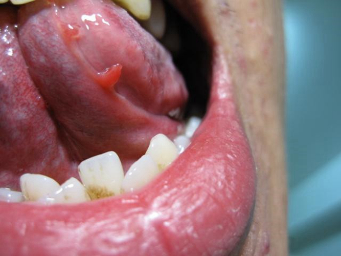 舌下尖锐湿症状图片图片