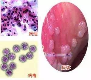 解决尖锐湿疣疾病的正确方法