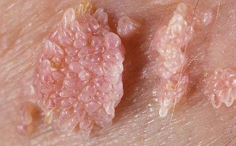女性尖锐湿疣的症状特征是什么，尖锐湿疣能根治吗