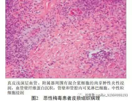 梅毒症状、治疗和预防