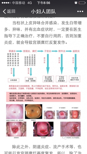 女性尖锐湿疣好治吗_女性尖锐湿疣初期_女性尖锐湿疣