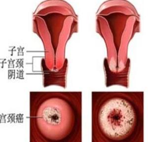 男性得了尖锐湿疣什么症状_口腔得了尖锐湿疣_得了尖锐湿疣