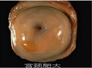 宫颈尖锐湿疣早期的症状