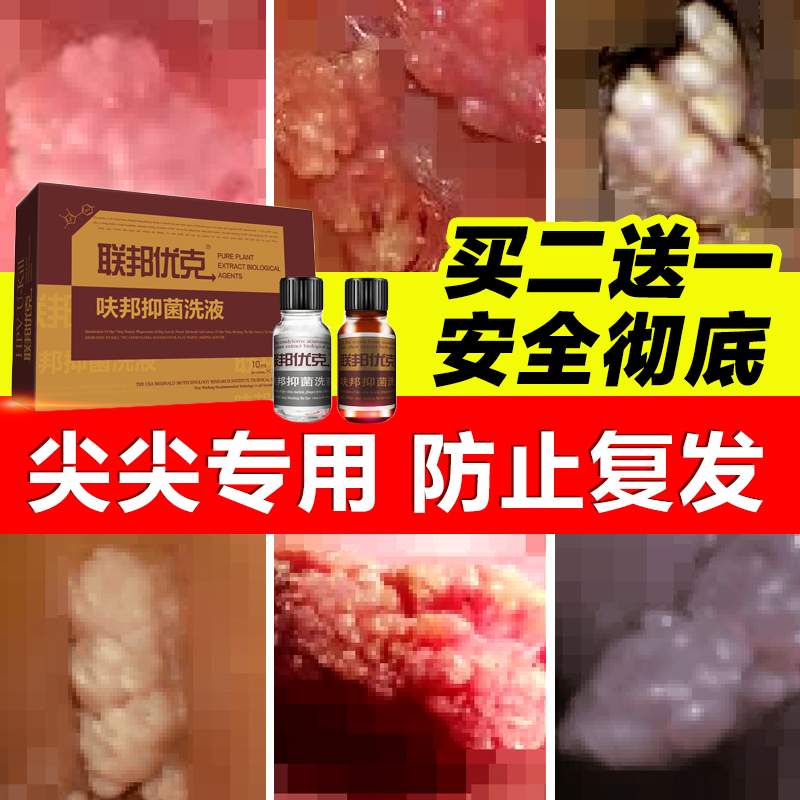 肛门 尖锐湿疣_肛门尖锐湿疣_男性肛门尖锐湿疣症状