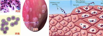 宫颈尖锐湿疣_宫颈尖锐湿疣症状_宫颈尖锐湿疣初期