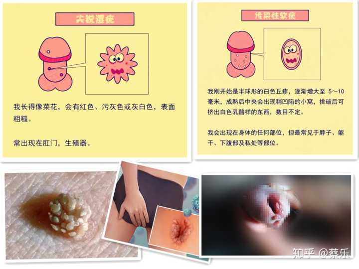 怎么区分珍珠疹和尖锐湿疣？
