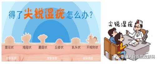 治疗尖锐湿疣有3招 日常护理要做好