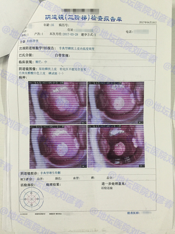 病例分享——尖锐湿疣会导致宫颈病变吗？