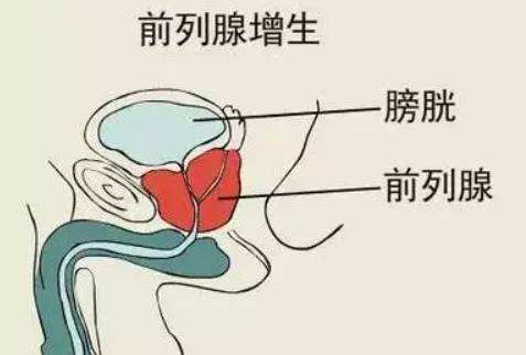 非淋病和淋病_淋病_淋病