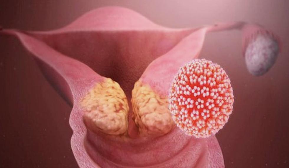 HPV感染就一定导致尖锐湿疣，宫颈癌吗？