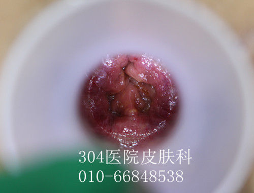 肛周尖锐湿疣 什么样的表现是肛周尖锐湿疣
