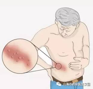 怎样治疗生殖器疱疹_生殖器疱疹怎么根治_生殖器疱疹