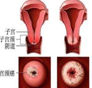 宫颈尖锐湿疣症状_宫颈尖锐湿疣常见吗_宫颈尖锐湿疣