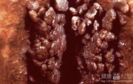 女性尖锐湿疣症状 它有哪些症状
