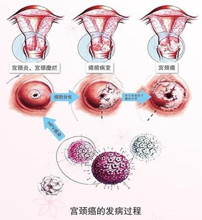 宫颈尖锐湿疣症状_宫颈尖锐湿疣_宫颈尖锐湿疣