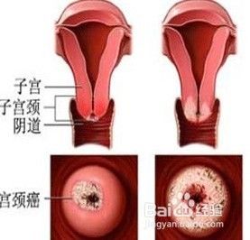 宫颈尖锐湿疣_宫颈尖锐湿疣症状_宫颈尖锐湿疣