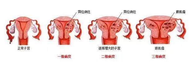 宫颈尖锐湿疣_宫颈尖锐湿疣的症状_宫颈尖锐湿疣常见吗