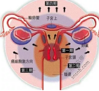 宫颈尖锐湿疣