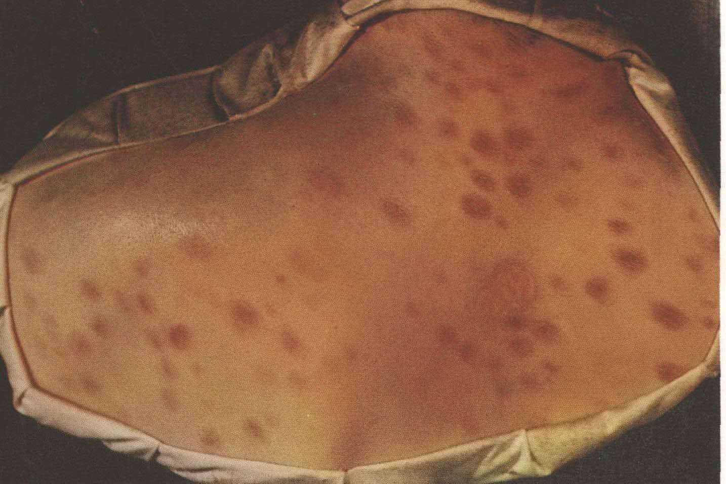 女性软下疳梅毒图片