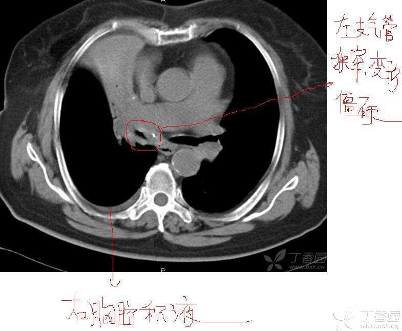 什么是软下疳_软下疳_硬下疳与软下疳