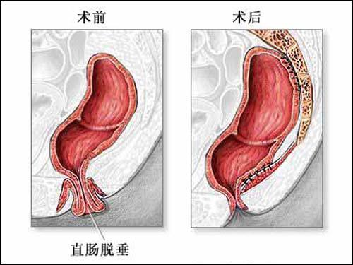 什么是软下疳_软下疳症状_软下疳